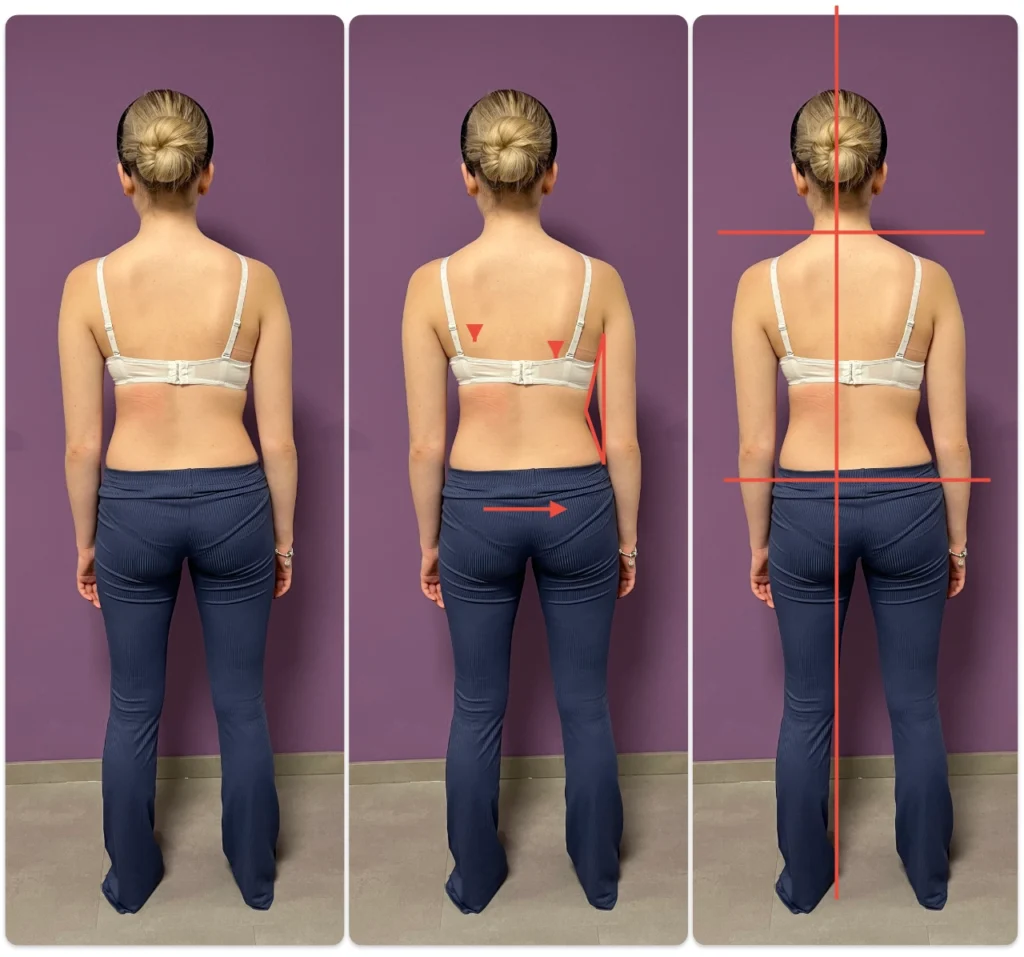 scoli-megfigyeles-kinesis-gyogytorna